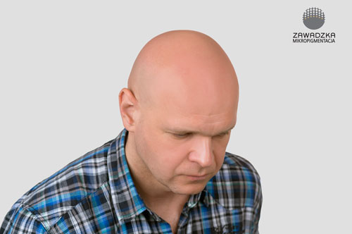 Mikropigmentacja skóry głowy - przed zabiegiem