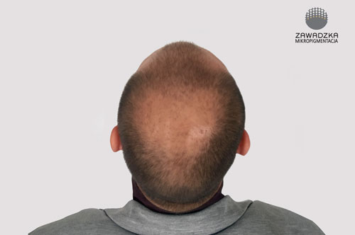 Mikropigmentacja skóry głowy - przed zabiegiem